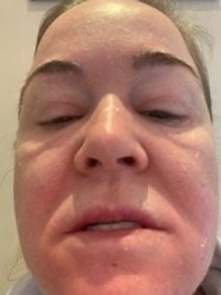 chemicalpeel1