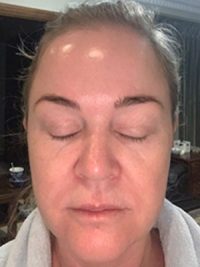 chemicalpeel2